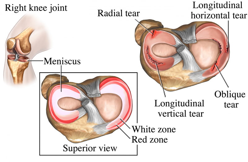 meniscus-injury